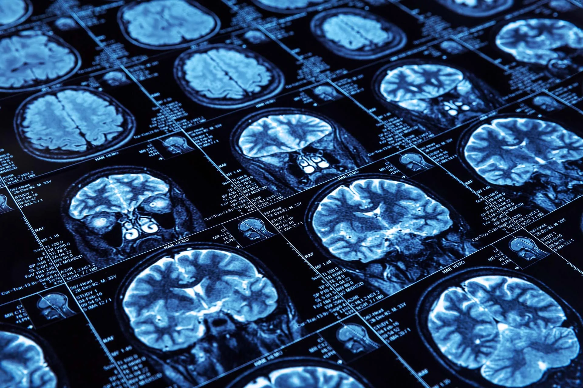The image shows multiple MRI brain scan slices arranged in a grid pattern. These scans are captured in shades of blue and white on a black background, providing detailed cross-sectional views of brain tissue. Each image slice varies slightly, showing different angles and sections of the brain. The scans are accompanied by various technical details and notes printed in white around each image, adding to the scientific and medical context of the presentation.