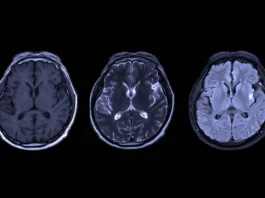 The image displays three axial MRI brain scans aligned horizontally against a black background. Each scan depicts different imaging techniques. The left scan, labeled T1-weighted, exhibits medium contrast, showing the brain's structural elements with a darker appearance of fluids. The middle scan, T2-weighted, shows increased fluid contrast, with bright areas indicating fluid presence, enhancing the visibility of certain brain structures. The right scan, FLAIR, demonstrates a similar contrast to T2 but with suppressed fluid signals, highlighting lesions and abnormalities clearer in soft tissues. All scans reveal the intricate patterns and symmetrical features of the brain's anatomy, emphasizing the cerebral hemispheres.