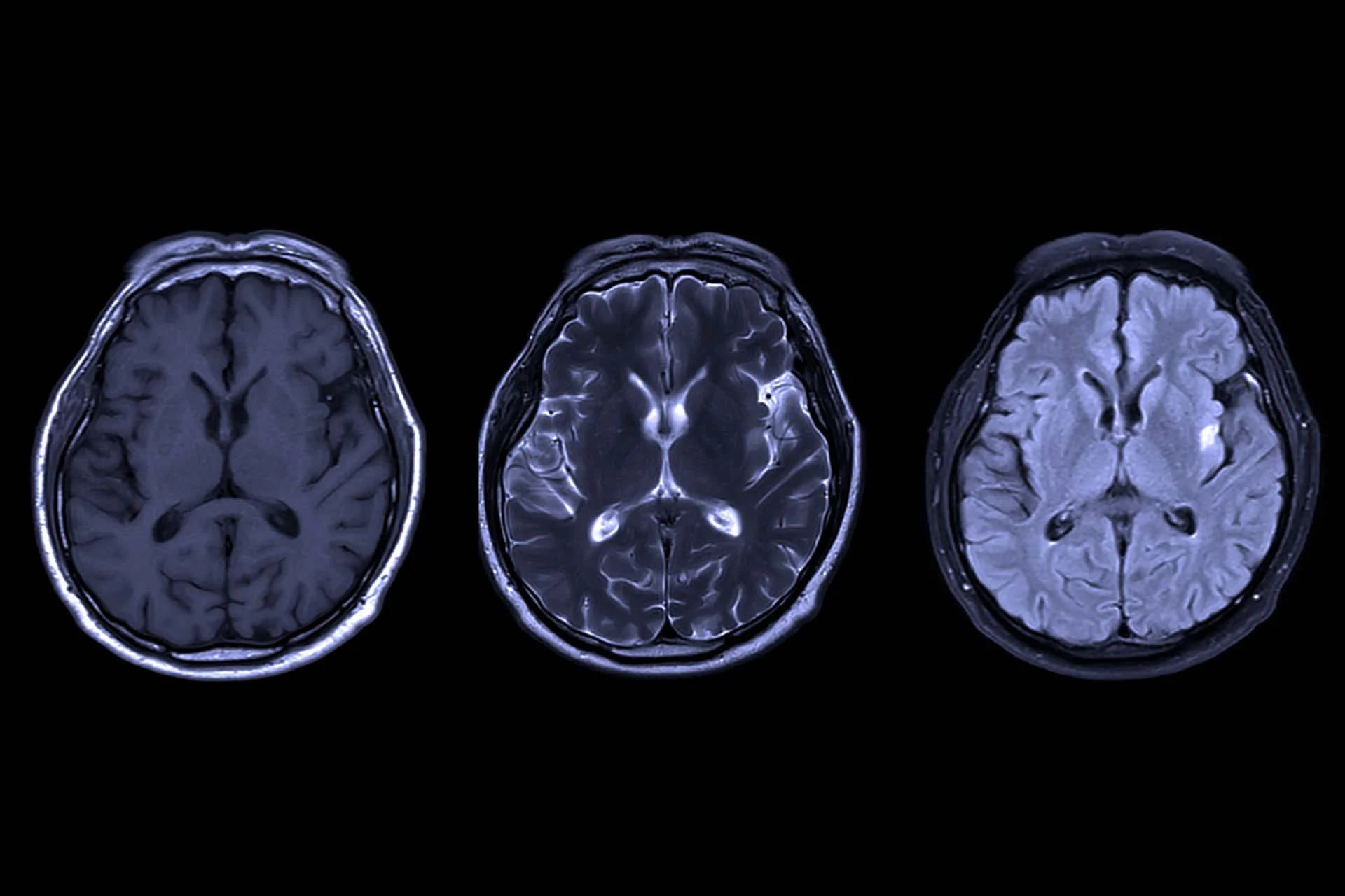 The image displays three axial MRI brain scans aligned horizontally against a black background. Each scan depicts different imaging techniques. The left scan, labeled T1-weighted, exhibits medium contrast, showing the brain's structural elements with a darker appearance of fluids. The middle scan, T2-weighted, shows increased fluid contrast, with bright areas indicating fluid presence, enhancing the visibility of certain brain structures. The right scan, FLAIR, demonstrates a similar contrast to T2 but with suppressed fluid signals, highlighting lesions and abnormalities clearer in soft tissues. All scans reveal the intricate patterns and symmetrical features of the brain's anatomy, emphasizing the cerebral hemispheres.