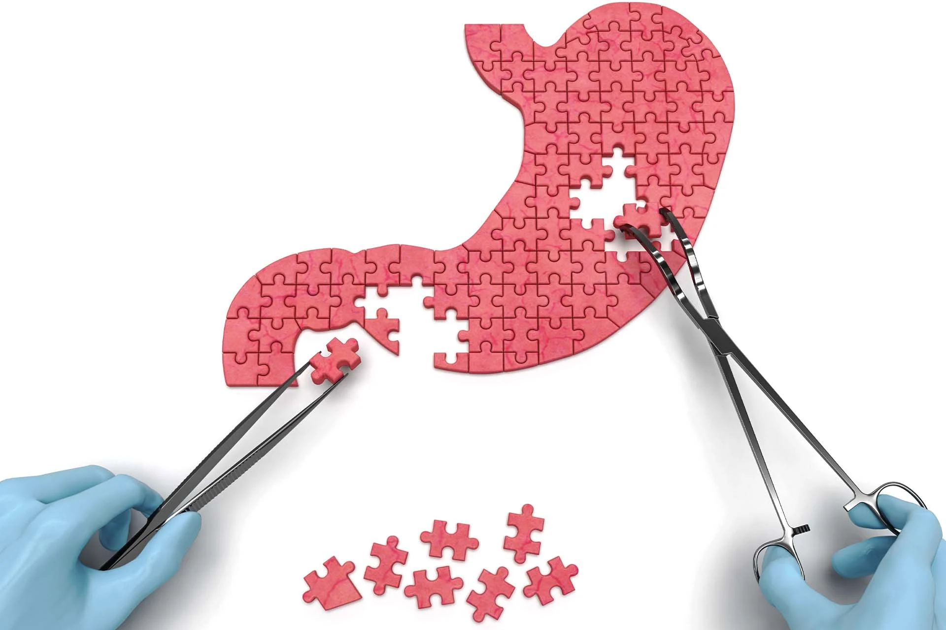 The image depicts a stylized representation of a human stomach as a red jigsaw puzzle. Two hands, clad in blue surgical gloves, are holding tweezers to place puzzle pieces into the stomach shape. The stomach puzzle contains several missing pieces, and additional puzzle pieces are scattered below the stomach. The background is plain white, providing contrast to the bright red color of the stomach puzzle and the blue gloves.